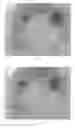 Fig. 03 - Systems and methods for percutaneous body lumen drainage