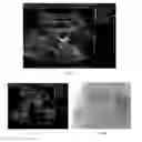 Fig. 04 - Systems and methods for percutaneous body lumen drainage