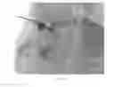 Fig. 05 - Systems and methods for percutaneous body lumen drainage