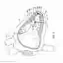 Fig. 02 - Implantable medical device with a movable electrode biased toward an extended position