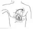 Fig. 01 - System for treating Brugada syndrome