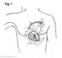 Fig. 02 - System for treating Brugada syndrome