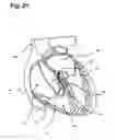 Fig. 28 - System for treating Brugada syndrome