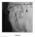 Fig. 30 - Methods of treating melanoma