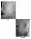 Fig. 35 - Methods of treating melanoma
