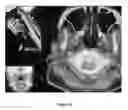 Fig. 48 - Methods of treating melanoma
