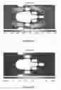 Fig. 05 - Microfluidic system for evaluation of chemotherapeutic and immunotherapeutic drugs