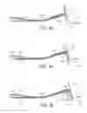 Fig. 04 - Reinforcing structure for a wind turbine blade
