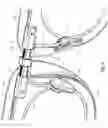 Fig. 06 - Variable power fluid cell optics for countering presbyopia and/or astigmatism