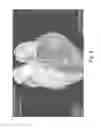 Fig. 06 - Fractional flow reserve determination