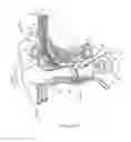 Fig. 02 - System for adjusting magnetic retention force in auditory prostheses