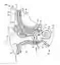 Fig. 01 - Medical device having an impulse force-resistant component