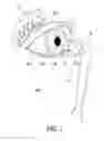 Fig. 02 - Ocular devices and methods for the employment thereof