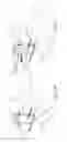 Fig. 09 - Patient specific instruments and methods for joint prosthesis