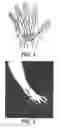 Fig. 02 - ORTHOPEDIC FASTENER DEVICE