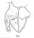 Fig. 02 - Percutaneously-deployable prosthetic tricuspid valve