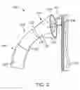 Fig. 04 - Delivery system for anchor and method