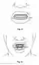 Fig. 10 - Breathing assist device