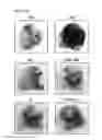Fig. 13 - Composition for preventing or treating vascular leak syndrome