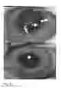 Fig. 08 - Composite collagen hydrogel material, an implantable opthalmic device comprising such material and methods of producing the composite collagen hydrogel material and the implantable ophthalmic device