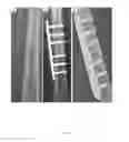 Fig. 05 - COMPOSITIONS AND METHODS FOR TREATMENT OF BONE DEFECTS