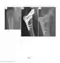 Fig. 06 - COMPOSITIONS AND METHODS FOR TREATMENT OF BONE DEFECTS