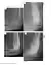 Fig. 07 - COMPOSITIONS AND METHODS FOR TREATMENT OF BONE DEFECTS