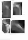 Fig. 11 - COMPOSITIONS AND METHODS FOR TREATMENT OF BONE DEFECTS