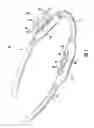 Fig. 02 - Apparatus and method for cannulation of vascular access graft
