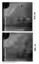 Fig. 02 - Detection of lead electrode dislodgement using cavitary electrogram