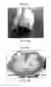 Fig. 04 - DIPOLE ELECTRICAL STIMULATION EMPLOYING DIRECT CURRENT FOR RECOVERY FROM SPINAL CORD INJURY