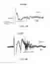 Fig. 09 - DIPOLE ELECTRICAL STIMULATION EMPLOYING DIRECT CURRENT FOR RECOVERY FROM SPINAL CORD INJURY