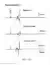 Fig. 29 - DIPOLE ELECTRICAL STIMULATION EMPLOYING DIRECT CURRENT FOR RECOVERY FROM SPINAL CORD INJURY