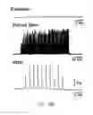 Fig. 33 - DIPOLE ELECTRICAL STIMULATION EMPLOYING DIRECT CURRENT FOR RECOVERY FROM SPINAL CORD INJURY