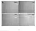 Fig. 07 - Intratumoral modulation therapy