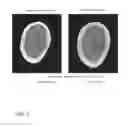 Fig. 03 - REMINERALISATION OF CALCIFIED TISSUE