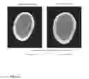 Fig. 03 - Remineralisation of calcified tissue