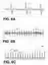 Fig. 07 - Wearable cardioverter defibrillator (WCD) system computing patient heart rate by multiplying ECG signals from different channels