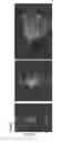 Fig. 04 - ETS factors regulate neural stem cell depletion and gliogenesis in Ras pathway glioma