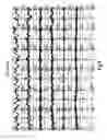 Fig. 04 - Detection of the heartbeat in cranial accelerometer data using independent component analysis