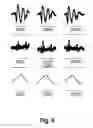 Fig. 05 - Detection of the heartbeat in cranial accelerometer data using independent component analysis