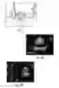 Fig. 13 - Methods, systems and computer program products for single track location shear wave elasticity imaging