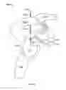 Fig. 13 - Shape memory filament for suture management