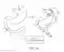 Fig. 02 - Devices and methods for forming an anastomosis