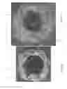Fig. 23 - Delivery system for micrograft for treating intracranial aneurysms