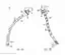 Fig. 04 - Intramedullary fixation system for management of pelvic and acetabular fractures