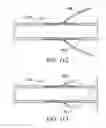 Fig. 117 - Clot retrieval system