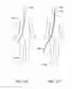 Fig. 127 - Clot retrieval system