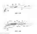Fig. 137 - Clot retrieval system