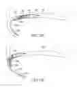 Fig. 138 - Clot retrieval system